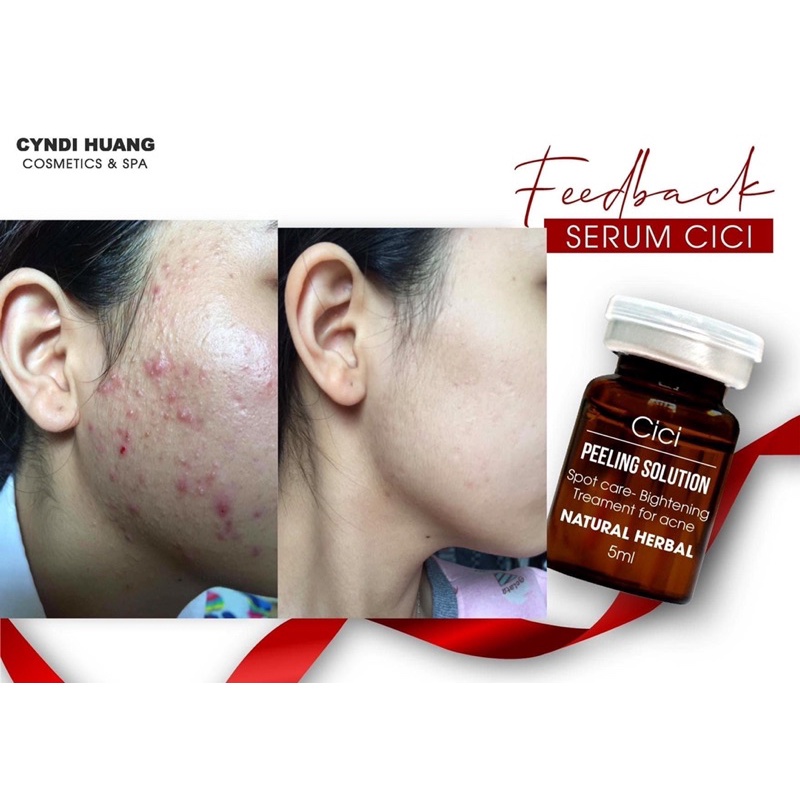Serum mụn Cici
