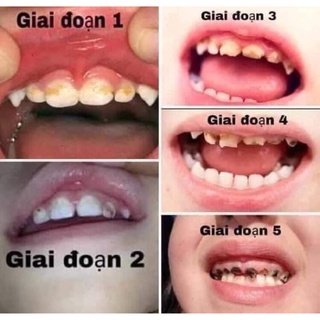 vecni flour phòng sâu răng/ sún răng/ ê buốt răng