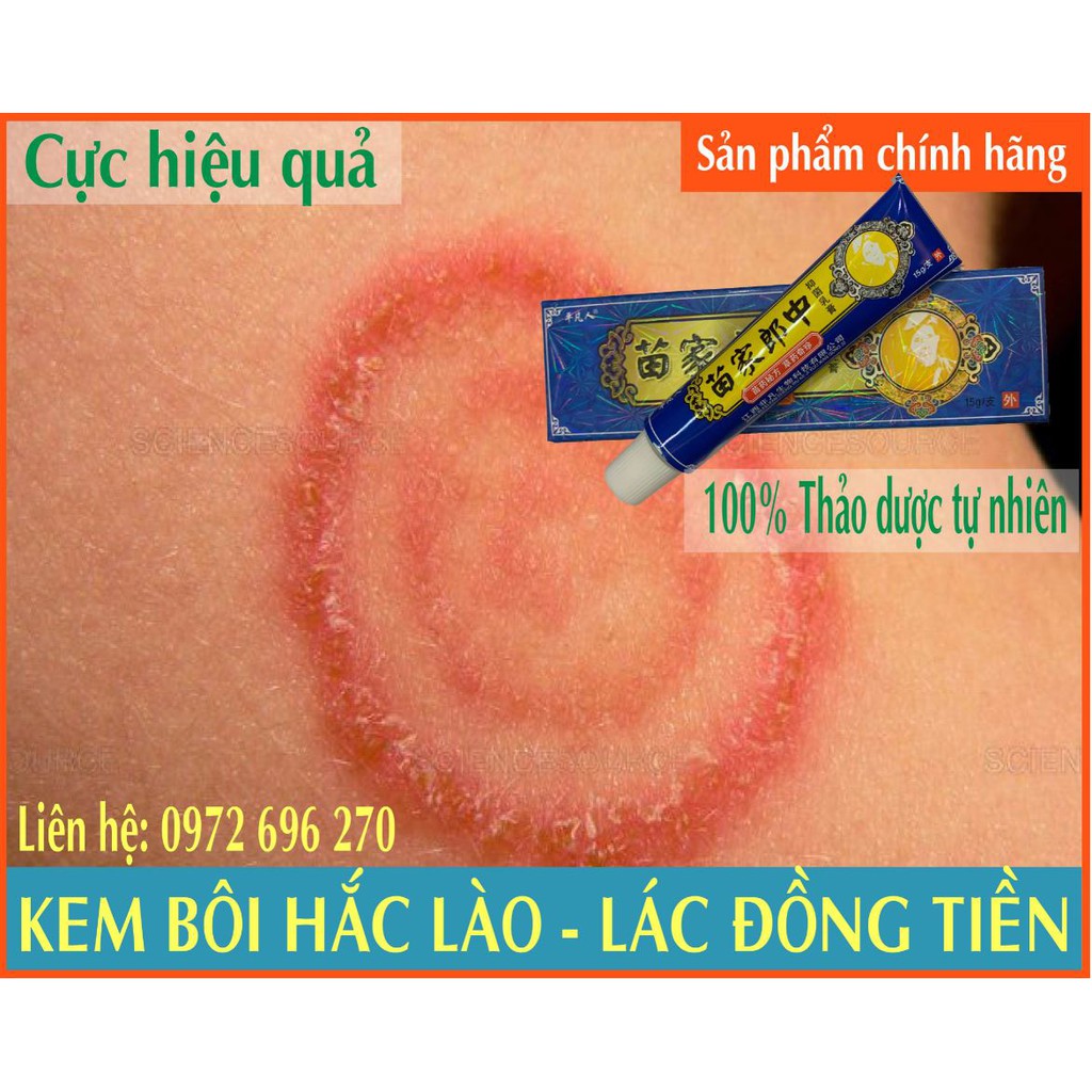 ✅ Kem bôi Hắc Lào - Lác Đồng Tiền [Cực hiệu quả]