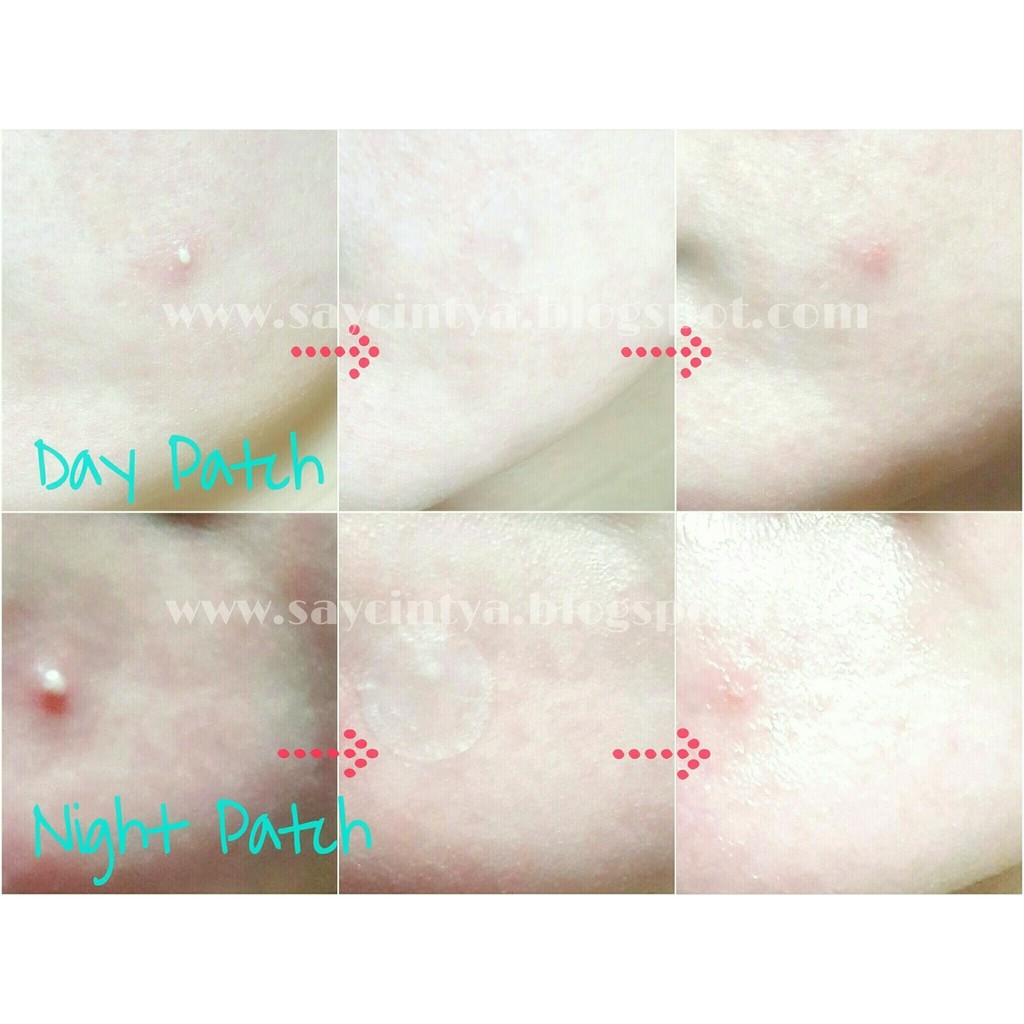 Miếng dán mụn Acne Patch Derma Angel Hasaki Sản Phẩm Chính Hãng