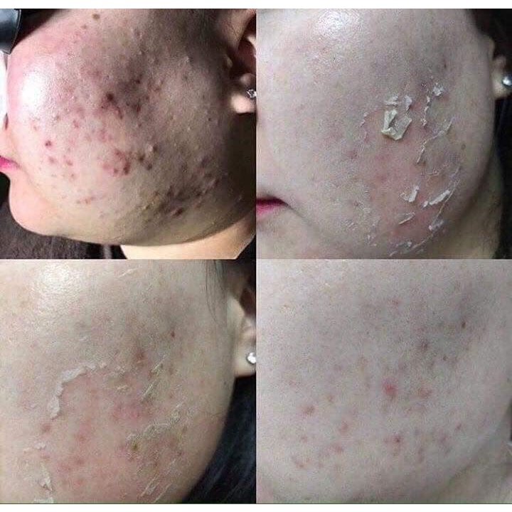 Thay da sinh học B-TOX PEEL Skin Renewal System - Tách lẻ