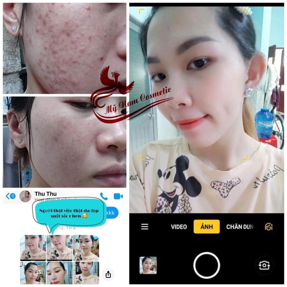 Combo dưỡng da mỹ nam -cải thiên tận gốc mụn, thâm nám, tàn nhang