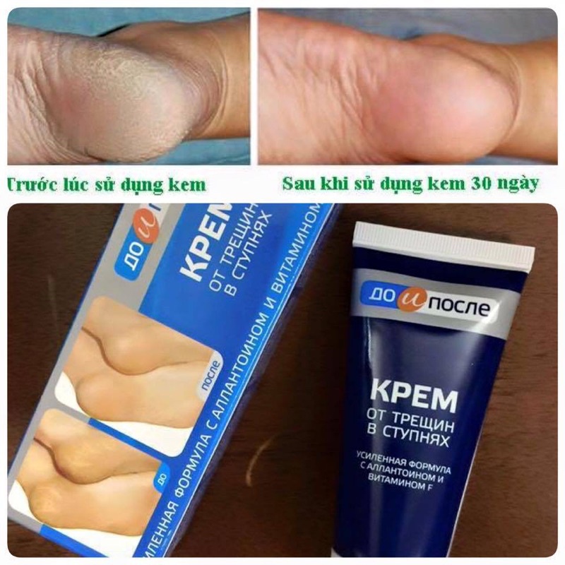 Kem bôi nứt gót chân 50ml