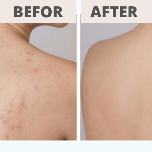 Hết mụn lưng ngực với 20 gói Thảo dược xông tắm Đông y gia truyền Thông Cát (Since 1918) | BigBuy360 - bigbuy360.vn