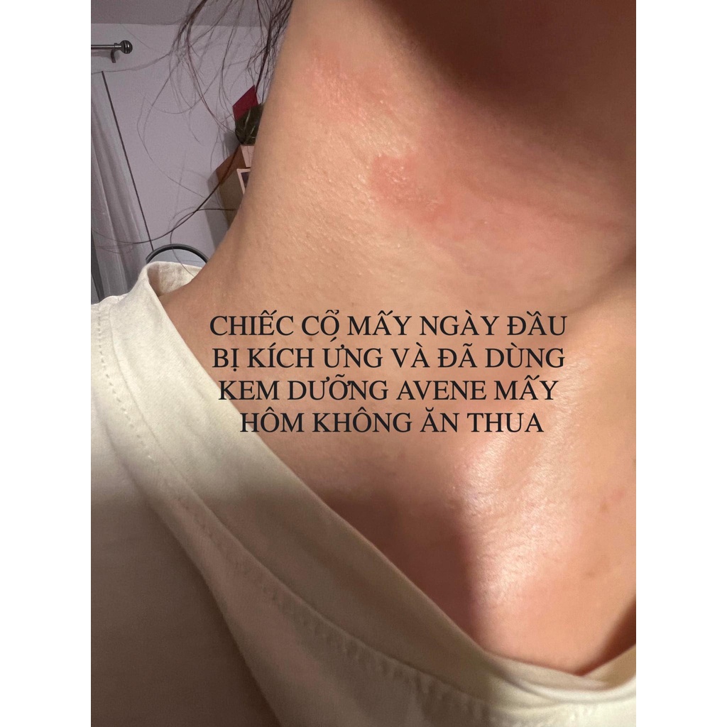 Kem dưỡng liền sẹo A-derma ultra duo 100ml, ADerma Epitheliale A.H DUO tái tạo da, chống thâm, phục hồi da