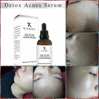 Serum Mụn Detox Acnes Kamel 10ml