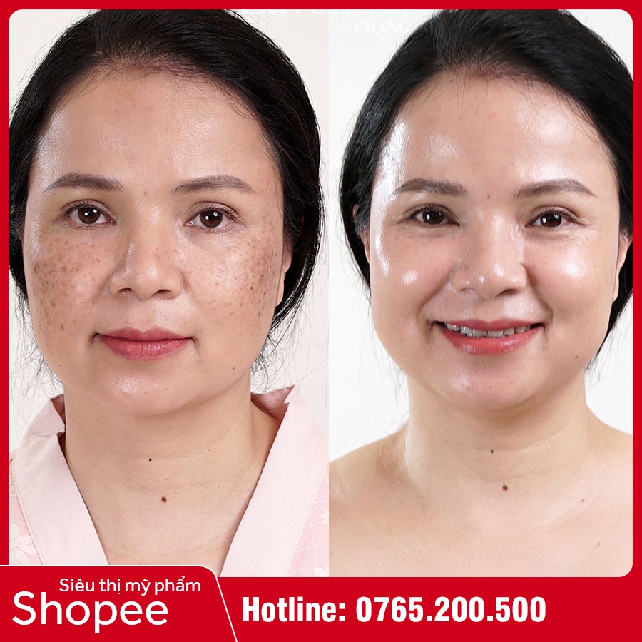 Kem Chống Nắng Mờ Nám Medi White - Medi UV Melasma - Bảo Vệ Da, Ngừa Sạm Nám, Tàn Nhang | BigBuy360 - bigbuy360.vn