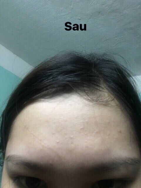 Kem Làm Giảm Mụn Pair Nhật Bản | BigBuy360 - bigbuy360.vn