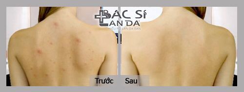 Xịt ngăn ngừa và giảm mụn lưng FOR BACK | BigBuy360 - bigbuy360.vn