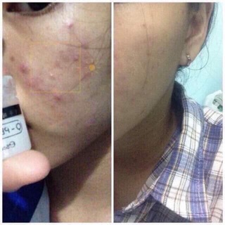 Kem trị thâm Juihe Q – Pearl