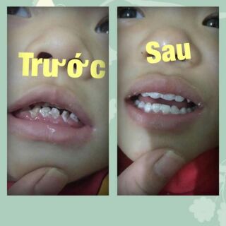 Kem bôi chống sâu răng , sún răng