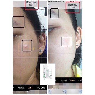 Chấm Mụn- Xẹp Mụn 24h