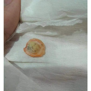 Miếng Dán Mụn Cóc ( Hiệu quả )