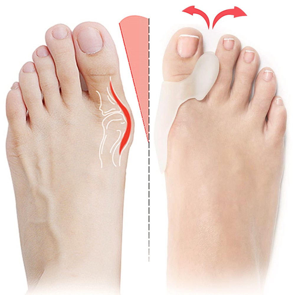 Cặp gel silicone JUNLAIKANG phân tách chữa lệch và nốt tấy ngón chân cái chăm sóc bàn chân
