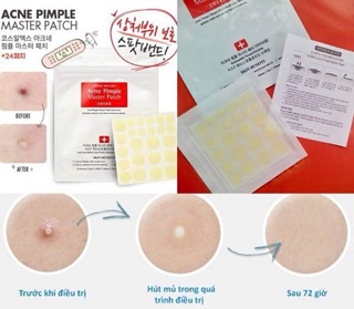 Miếng dán mụn COSRX