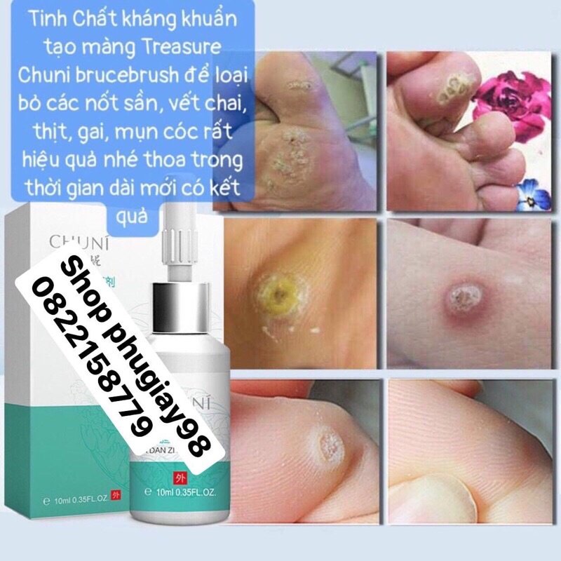 Kem bôi ngoài da hỗ trợ mụn cóc, mụn cơm, mụn mắc cá chân, mụn thịt , mụn ruồi , vết chai sần ở da dung tích 10ml