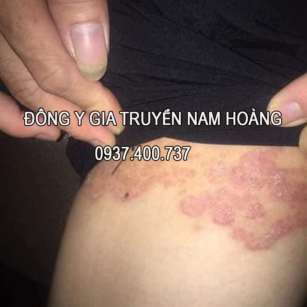 Thuo.c Tri Hắc Lào, Vảy Nến, Tri Hăm, Chàm Sữa, Rôm Sảy, Viem Da, Lang Ben, Á Sừng