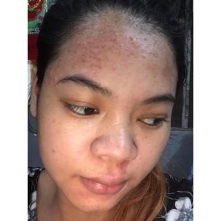 [Chính Hãng]Cao mụn sâm đỏ full size 15g