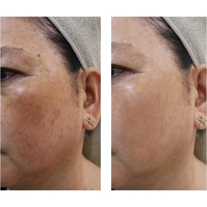 Combo Nám 6 Bạch Linh - Bách Y Sâm