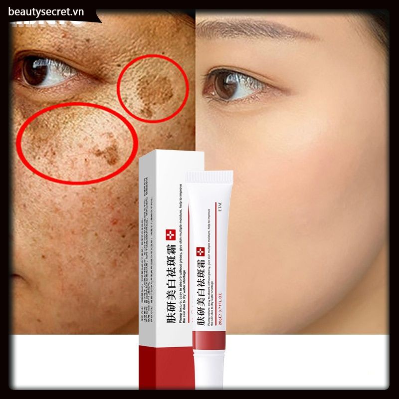 Kem cải thiện tình trạng tàn nhang làm trắng sáng da chống lão hóa 20g