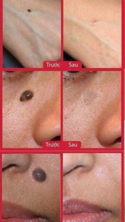 Tẩy Mụn Ruồi Nga