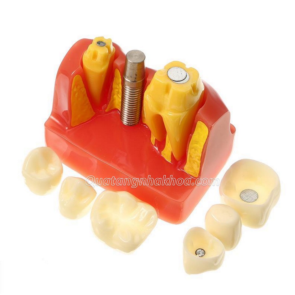 Mô hình hàm tư vấn so sánh cầu răng và implant - Mô hình răng thực hành nha khoa