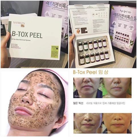 Thay da sinh học B-tox Peel