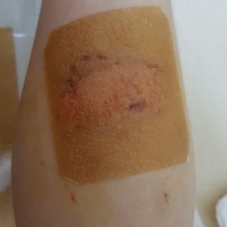 Duoderm ET/ Hydroactive Gel (date2026)