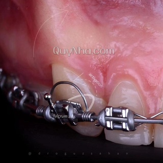 Torque chỉnh nha ( sản phẩm dùng trong nha khoa )