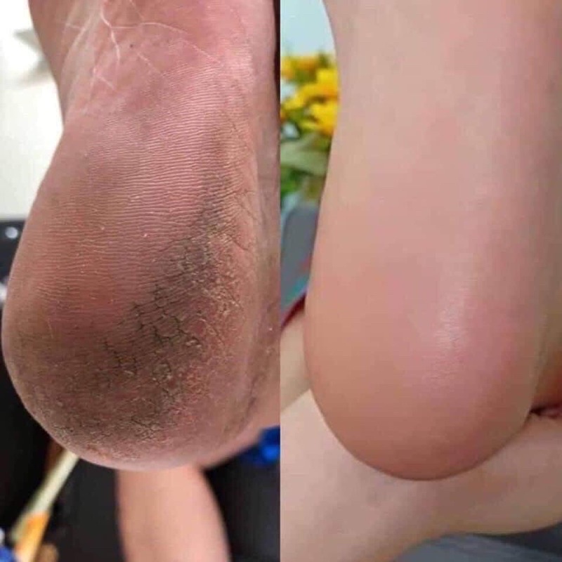 Kem dưỡng glysolid chăm sóc cho gót chân bị nứt nẻ, vẩy nến, á sừng