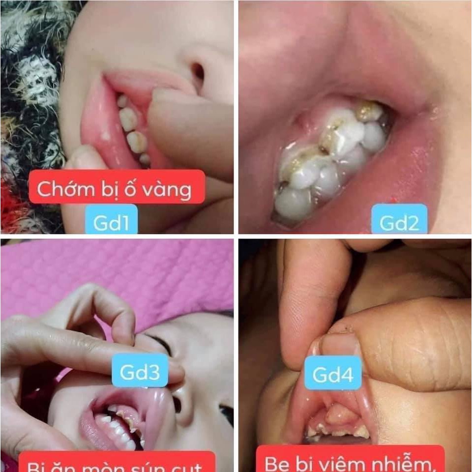 Thảo dược chà răng ố vàng, sún, sâu răng, nhiệt miệng cho trẻ em SR001