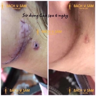 Cao sẹo bạch linh - bách y sâm -nhất mộc hương