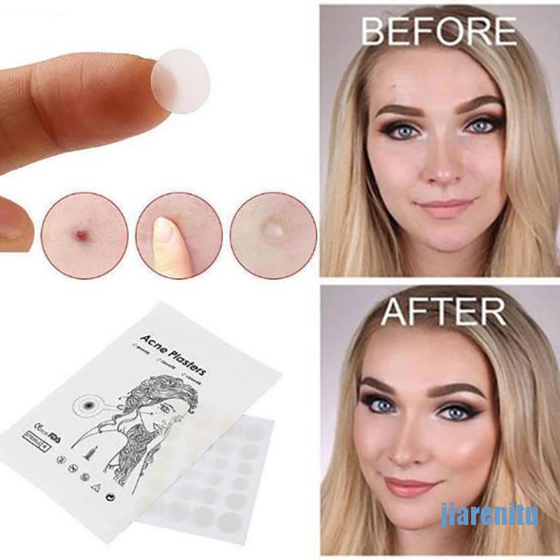 （hot*cod）36Pcs Skin Tag & Acne Patch Hydrocolloid Acne and Skin Tag Remover Patches