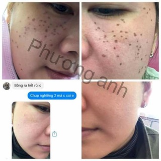 (Chính Hãng) Chấm tàn nhang Yody White Phương Anh