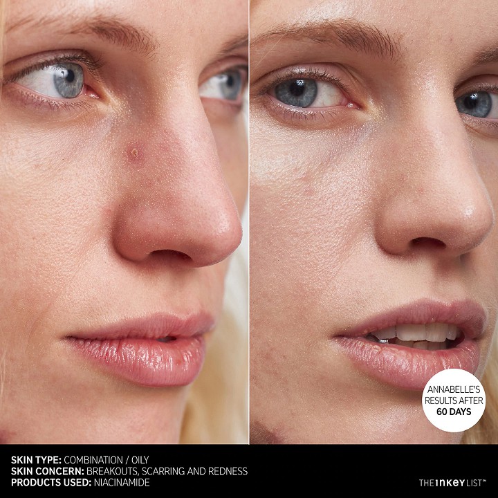 The INKEY List Niacinamide Oil Control Serum - Serum kiểm soát dầu nhờn và giảm mụn