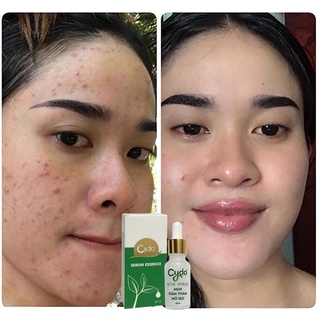 SERUM MỤN - GIẢM THÂM - MỜ SẸO CYDO