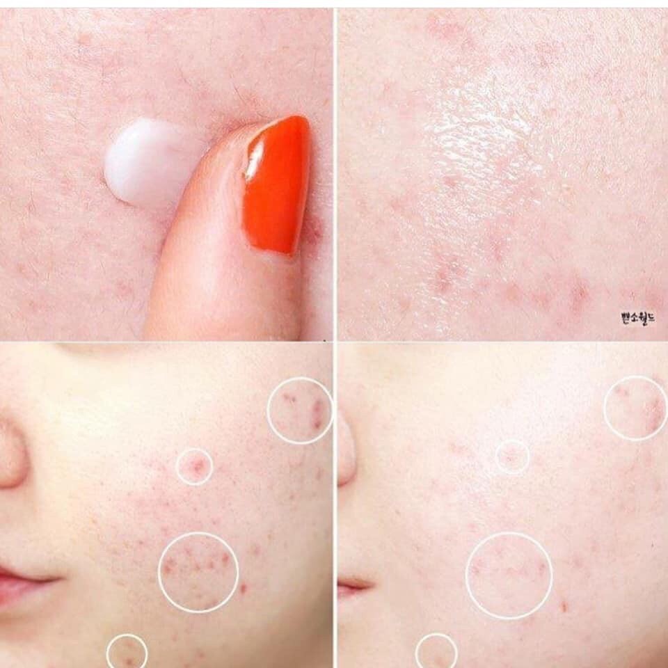 [Mã COS1904 giảm 8% đơn 300K] Kem Chấm Mụn Innisfree Bija Cica Balm EX 7ml Mẫu Mới | BigBuy360 - bigbuy360.vn