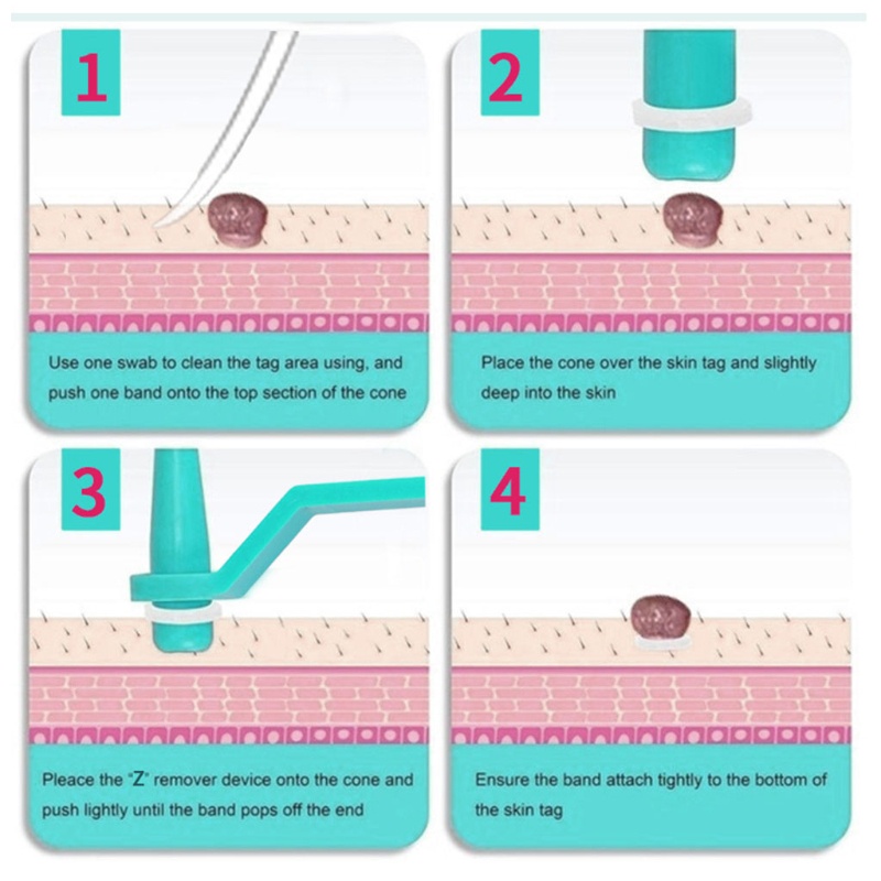 Bộ Dụng Cụ Loại Bỏ Mụn Trứng Cá Không Đau 2-8mm YOUYO