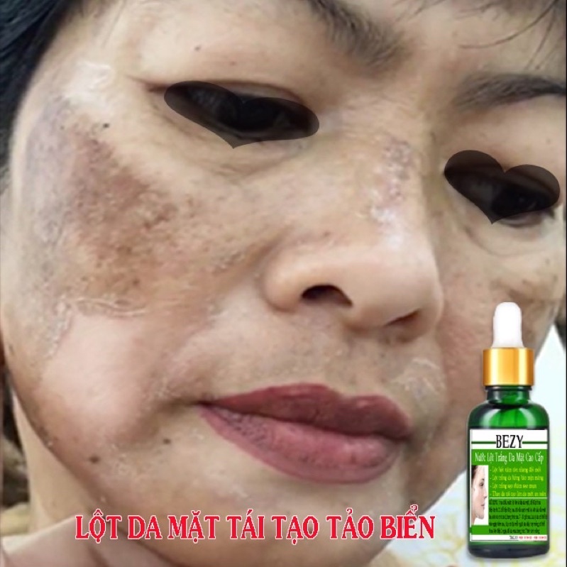 Tái Tạo Lột Thay Da Trắng Hết Nám Bezy