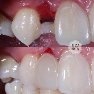 Dụng Cụ Nẹp Nẹp Nẹp / Thạch Anh