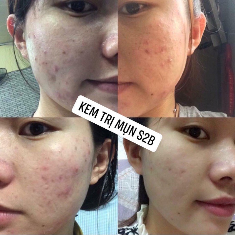 Kem Ngừa Mụn S2B Beauty