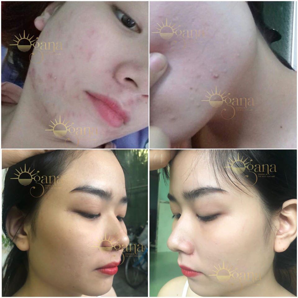 Bột rửa mặt OGANA cho da mụn