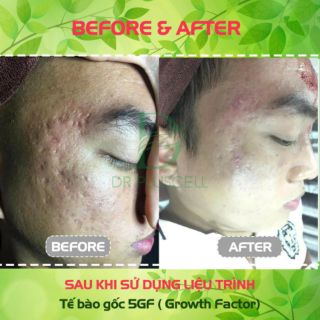 Tế Bào Gốc Sẹo 6GF Drpluscell Mới