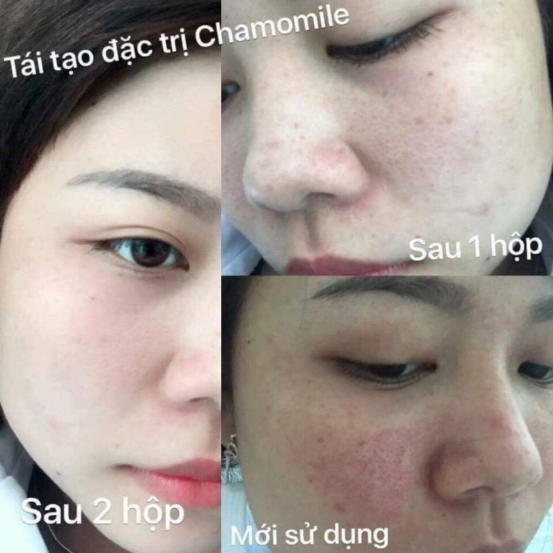 5 HỘP KEM CHAMOMILESKILL