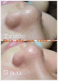 Nhíp Gắp Mụn Hàn Quốc Thần Thánh