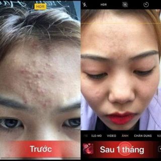 3 hũ nhỏ kem mụn