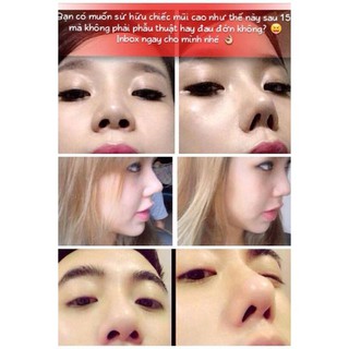 Sụn Nâng Mũi 3D Hàn Quốc