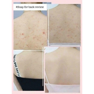 Xà phòng giảm mụn lưng for back