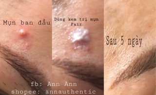 KEM TIÊU MỤN