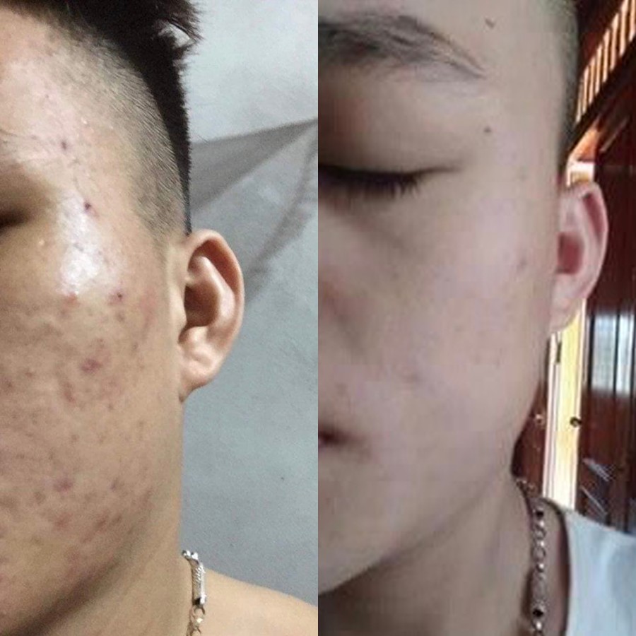 Tạm biệt da thô sần sùi chỉ với kem 3Day colagen